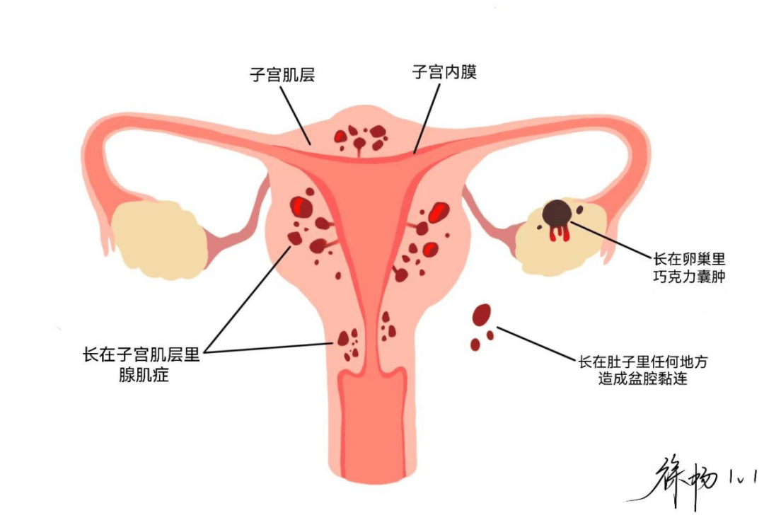 汉坎vs萨普斯堡08_带您汉坎vs萨普斯堡08了解“子宫内膜异位症”