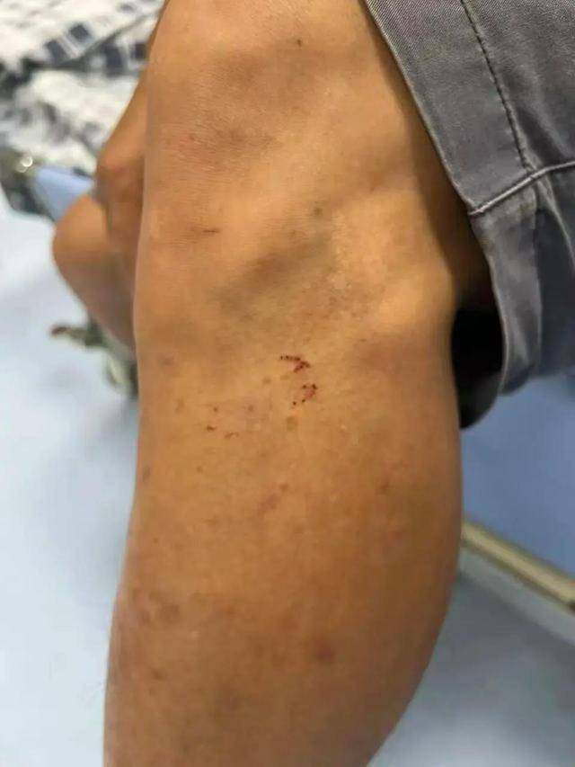 皇冠信用網登123出租_广东62岁阿叔网鱼网到2条眼镜蛇皇冠信用網登123出租，被咬伤后当场打死，并打包提进医院